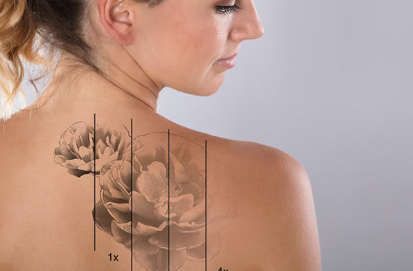 LASER TATTOO REMOVAL TRAINING