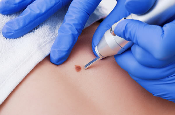 SKIN TAGS REMOVAL & SKIN ANATOMY TRAINING
